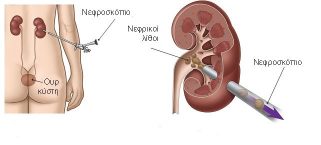 Διαδερμική νεφρολιθοτριψία