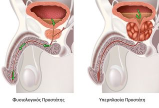 υπετροφια προστατη